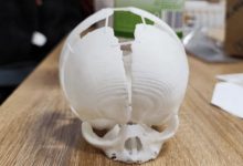 Фото - Ученые напечатали на 3D-принтере череп и спасли жизнь ребенку